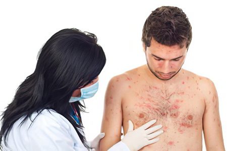 Symptoms and treatment of measles in adults