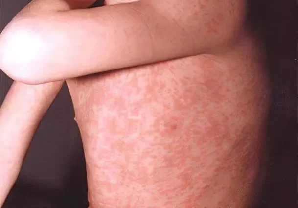 Symptoms and treatment of measles rubella