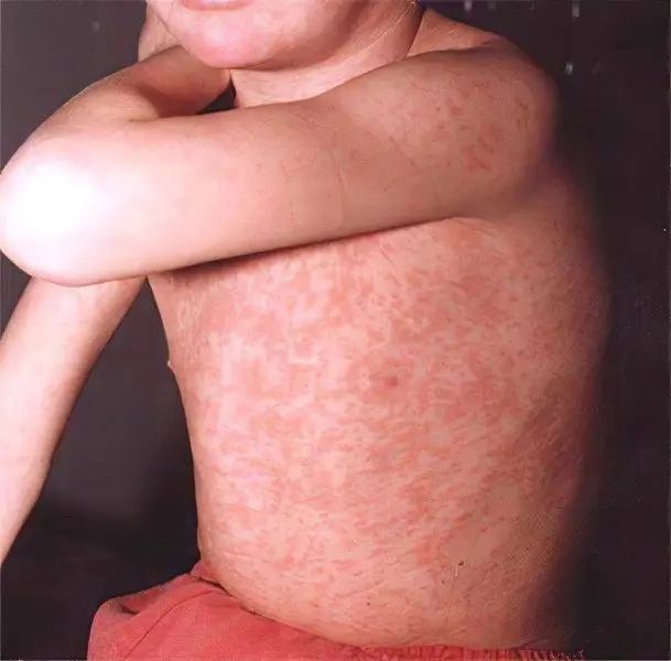 Symptoms and treatment of measles rubella