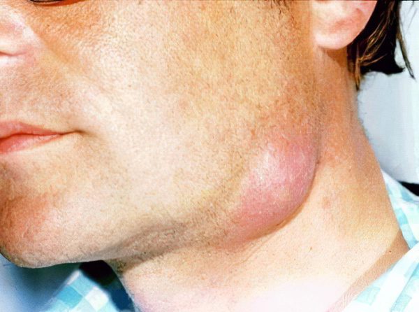 Symptoms and treatment of neck phlegmon