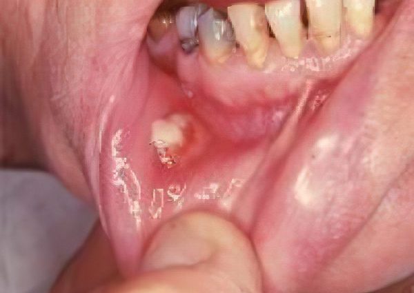 Symptoms and treatment of oral actinomycosis