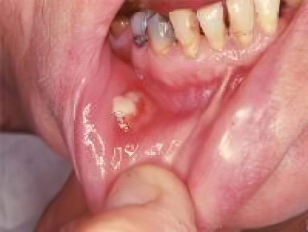 Symptoms and treatment of oral actinomycosis