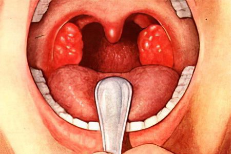 Symptoms and treatment of paratonsillar abscess