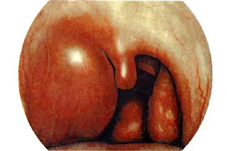 Symptoms and treatment of paratonsillar abscess