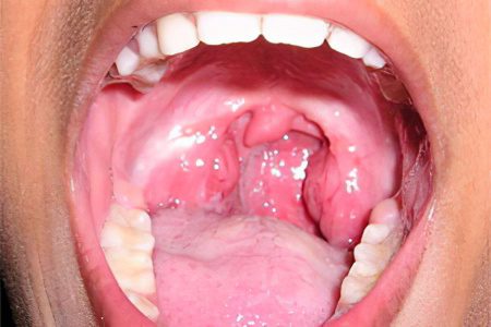 Symptoms and treatment of paratonsillar abscess