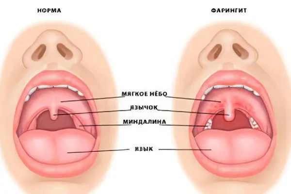 Symptoms and treatment of pharyngitis in adults