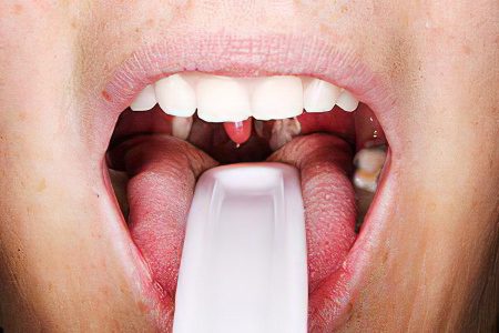 Symptoms and treatment of pharyngitis in adults