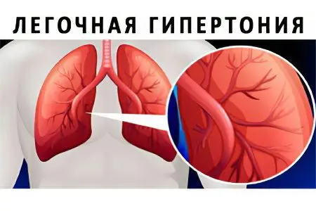 Symptoms and treatment of pulmonary hypertension