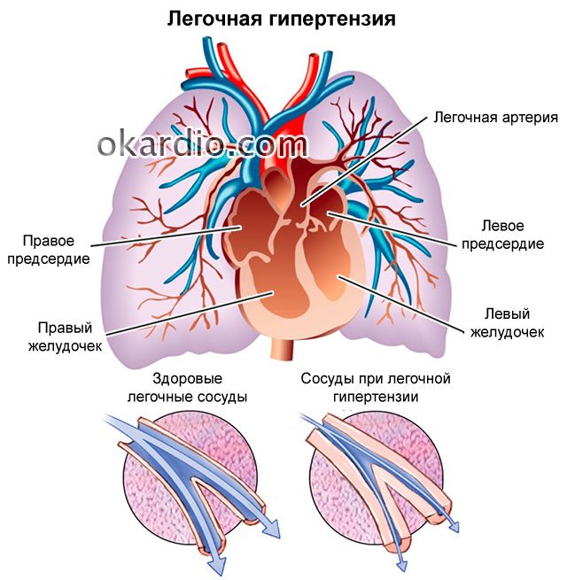 Symptoms and treatment of pulmonary hypertension