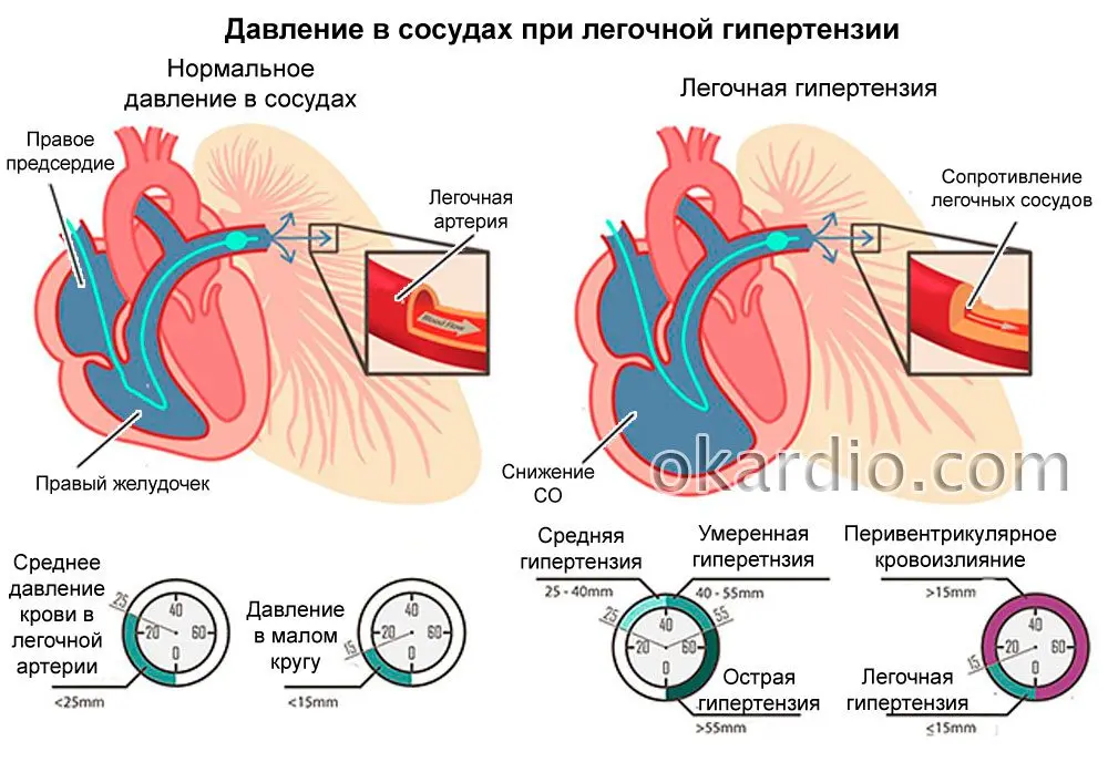 Symptoms and treatment of pulmonary hypertension