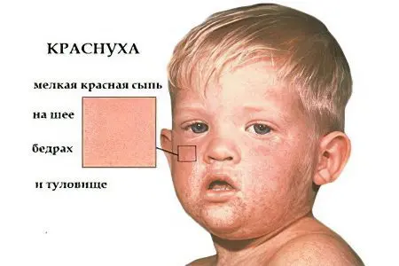 Symptoms and treatment of rubella in adults