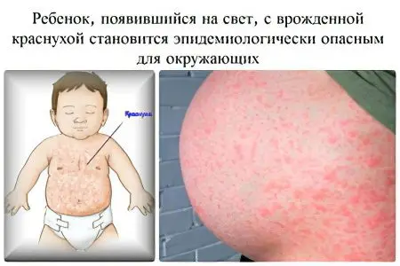 Symptoms and treatment of rubella in adults