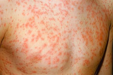 Symptoms and treatment of rubella in adults