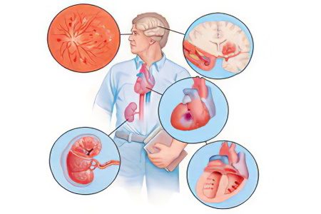 Symptoms, degrees and treatment of arterial hypertension