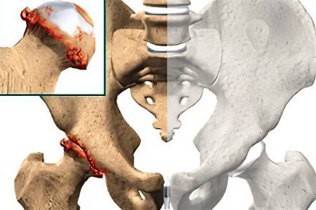 Symptoms, degrees and treatment of coxarthrosis of the hip joint