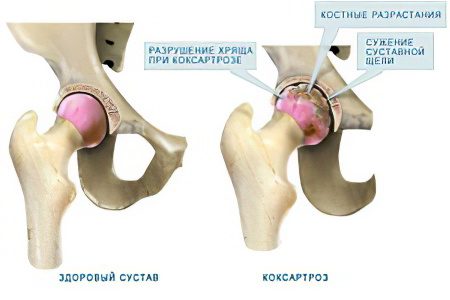 Symptoms, degrees and treatment of coxarthrosis of the hip joint