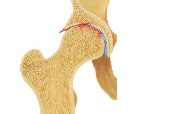 Symptoms, degrees and treatment of coxarthrosis of the hip joint