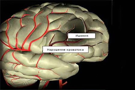 Symptoms, degrees, consequences and treatment of cerebral ischemia