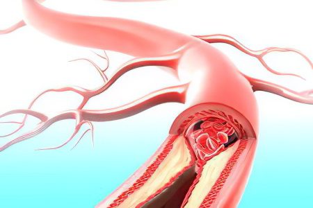 Symptoms, degrees, consequences and treatment of cerebral ischemia