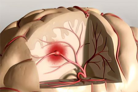 Symptoms, degrees, consequences and treatment of cerebral ischemia