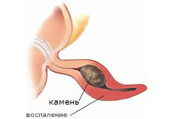 Symptoms of appendicitis