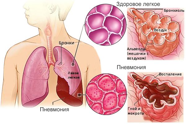 Symptoms of pneumonia: how to determine the disease even before it starts?