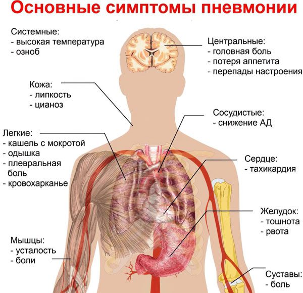 Symptoms of pneumonia: how to determine the disease even before it starts?