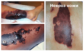 Symptoms of skin necrosis after surgery