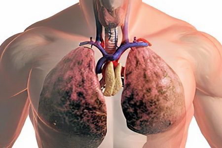 Symptoms, signs, stages and forms of pulmonary tuberculosis in adults