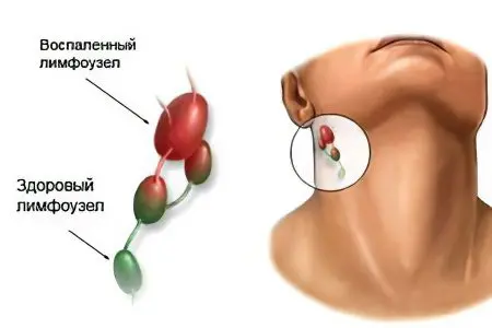 Symptoms, stages and treatment of lymph node cancer