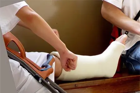 Symptoms, swelling and treatment of a broken leg