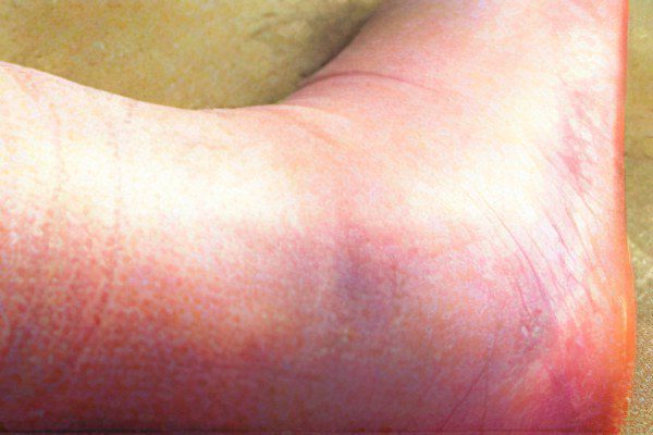 Symptoms, swelling and treatment of a broken leg