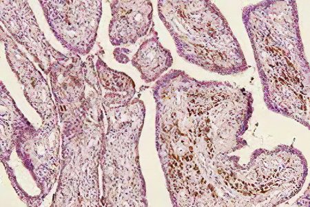 synovial sarcoma