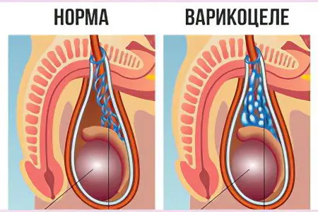 Testicular pain in men: causes and treatment