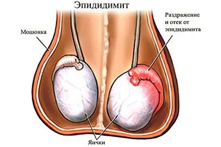 Testicular pain in men: causes and treatment