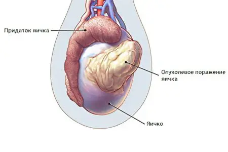 Testicular pain in men: causes and treatment