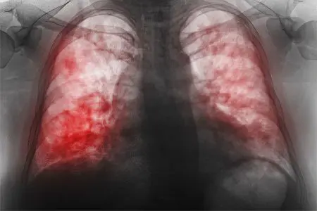 The 7 Most Dangerous Pneumonia Myths