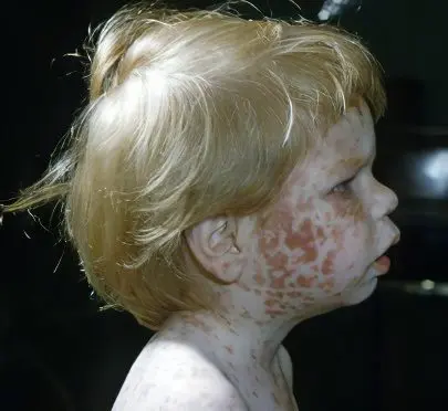 The consequences of rubella in children