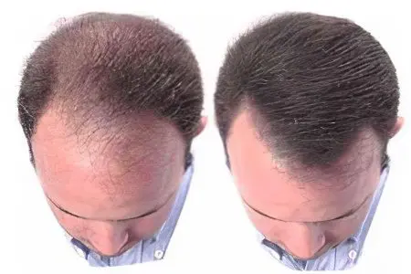 The drug Minoxidil for baldness: instructions for use