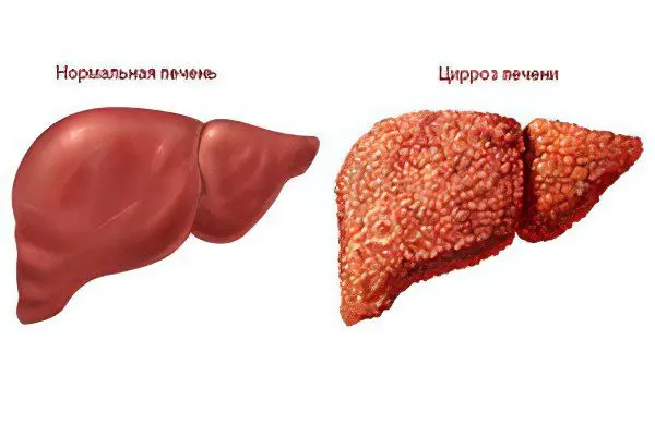 The first signs and symptoms of liver cirrhosis, causes, how to treat?