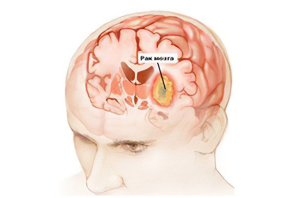 The first signs and symptoms, stages and treatment of brain cancer