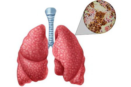 The first signs, symptoms, diagnostic methods and how is tuberculosis transmitted?