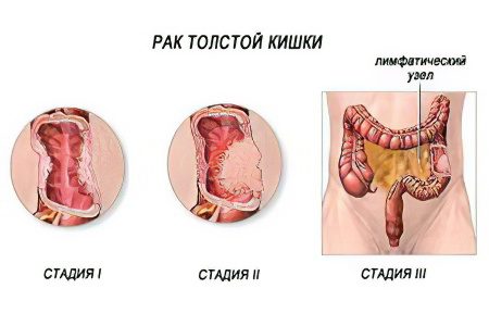 The first symptoms, stages and treatment of rectal cancer