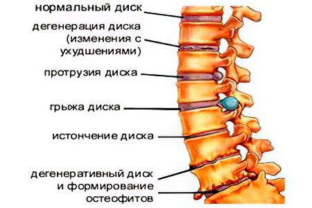 The use of chondroprotectors for spinal hernia