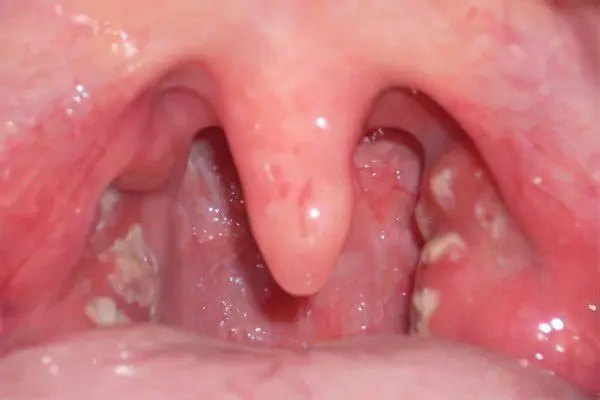 throat fungus