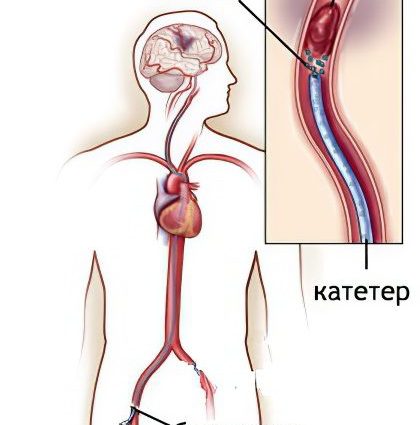 Thrombectomy &#8211; types of surgery, indications