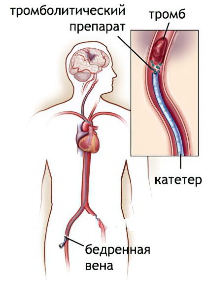 Thrombectomy - types of surgery, indications