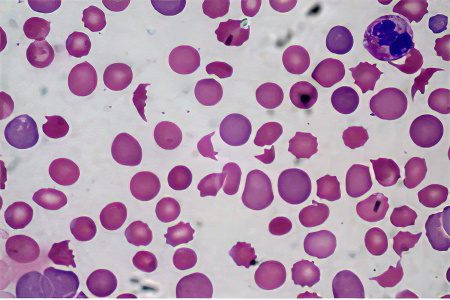 Thrombocytopenia - symptoms and treatment