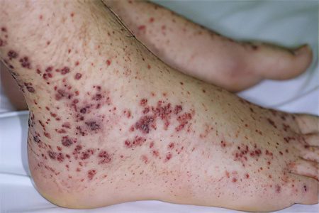 Thrombocytopenia - symptoms and treatment