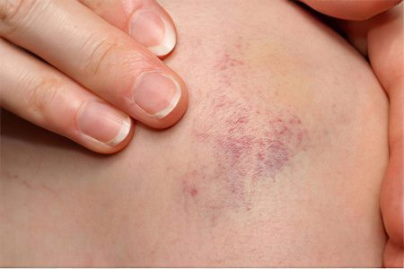 Thrombocytopenia - symptoms and treatment